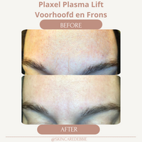 Plasma Lift behandeling voorhoofd en frons