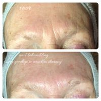 Resultaat na 1 Dermapeel behandeling