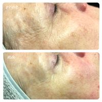 Resultaat na 1 Dermapeel behandeling