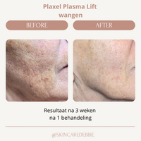 Plasma Lift wangen 1.