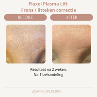 Plasma Lift behandeling Frons